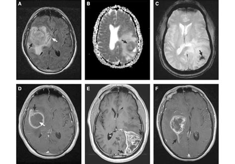 Typical MRI features of gliosarcomas. a FLAIR image demonstrating a ...