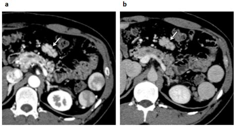 Diagnostics | Free Full-Text | A Multinodular Mass of Abdominal ...