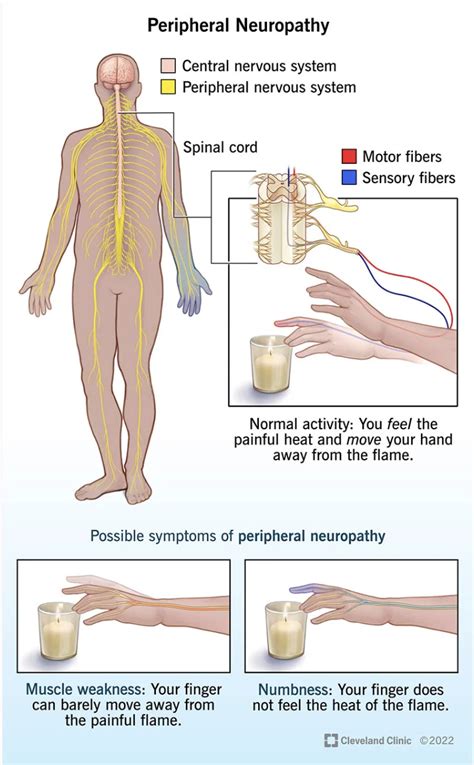 Finding your feet with peripheral neuropathy — Neurological ...