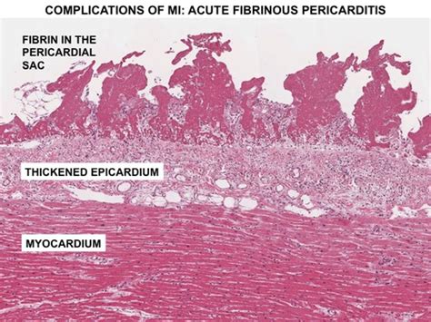 Visceral Pericardium Is Located