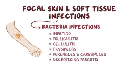 Skin and soft tissue infections: Clinical: Video | Osmosis