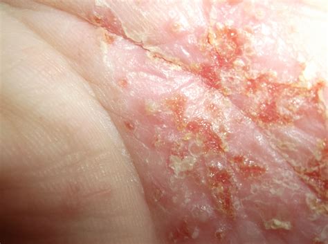 palmoplantar Pustular psoriasis | Pustular psoriasis, Palmoplantar ...