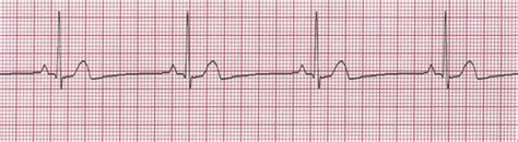 Heart Rhythm Strips Flashcards Quizlet