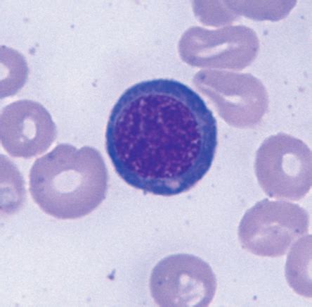 Rbc Disorder Abnormal Hematology Kodachrome Flashcards Quizlet