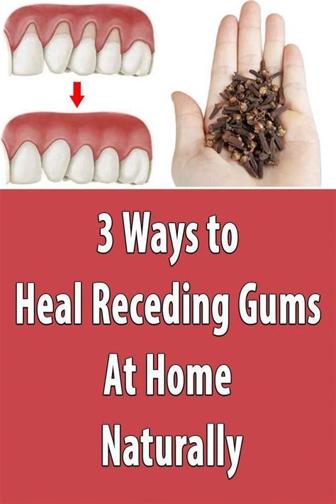 10 Easy Ways To Heal Receding Gums Naturally Receding Gums Tooth