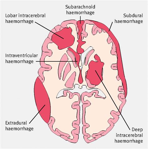 Types Of Hematomas In Brain John Wade Bruidstaart