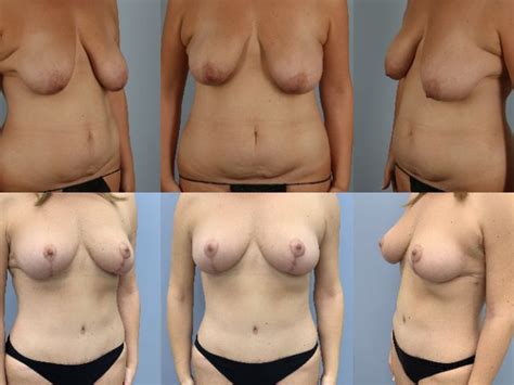 Breast Lift Auto Augmentation Non Implant Lift Case 10480 Scott Spiro MD