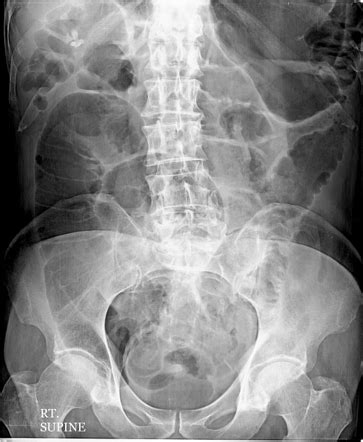 Abdominal Radiography Radiology Reference Article Radiopaedia Org