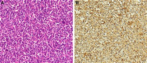 Pathological Findings Of The Surgically Resected Tumors A