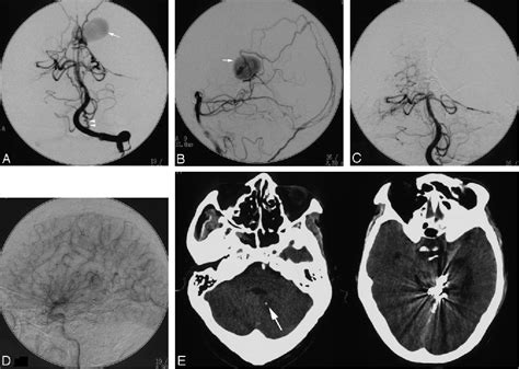 Figure From Dural Arteriovenous Fistulas In Patients Transarterial