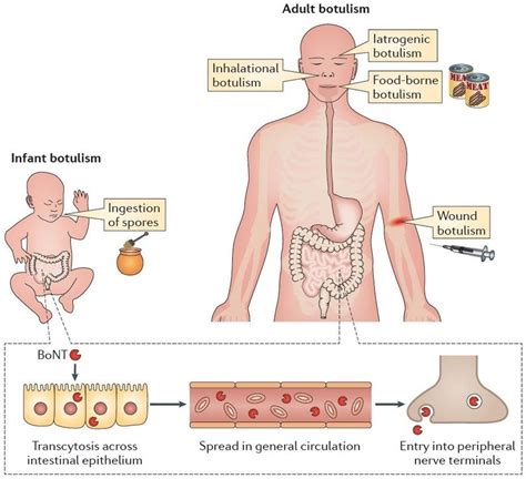 Human Form Of Botulism From Rossetto Et Al Botulinum