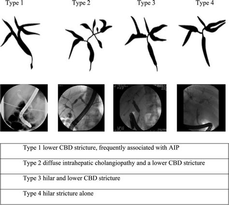 Classification Of IgG4 SC By Cholangiographic Features Type 1 IgG4 SC