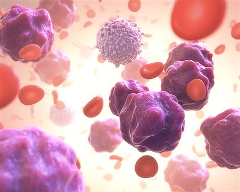 Measurable Residual Disease Mrd In Acute Myeloid Leukemia Aml