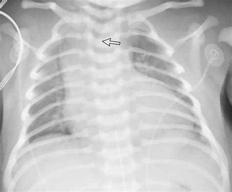 Cyanotic And Acyanotic Congenital Heart Disease Radiology Key