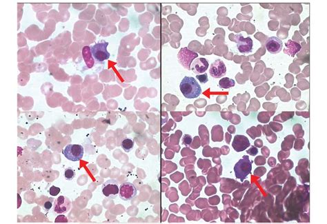 Plasma Cell Morphology In Bone Marrow Smears After Treatment