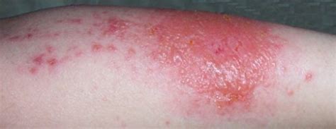 Contact Dermatitis, Scabies, Staph, Strep, or MRSA. Name that Rash.