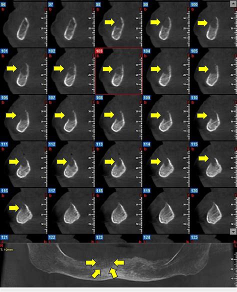 Three Dimensional Radiographical Imaging Of The Osteolytic Lesion In