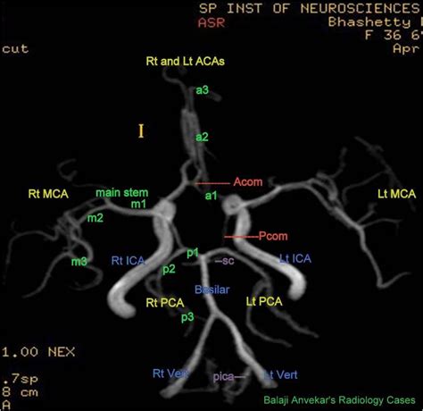 Neuroradiology Cases: Circle of Willis Anatomy | 신경 과학, 신경계, 초음파