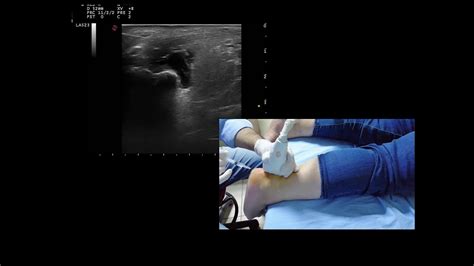 Ultrasound Guided Retrocalcaneal Bursitis And Achilles Tendinitis Injection Youtube