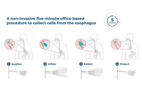 Noninvasive Testing For Esophageal Cancer Is Now Possible With Esoguard