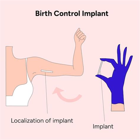 Ilustración De Implante Anticonceptivo En Vector Vector Premium