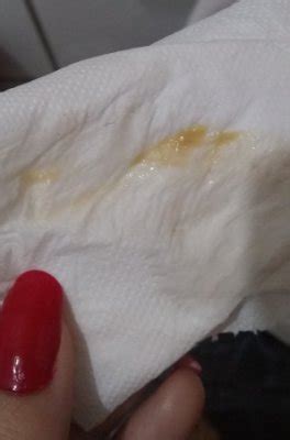 Corrimento Amarelo Sem Cheiro E Coceira - Corrimento amarelado tipo catarro | BabyCenter