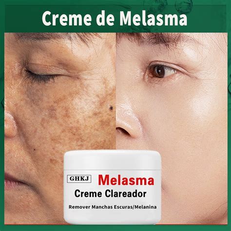 Creme Clareador Para Remover Melasma Manchas Escuras Melanina