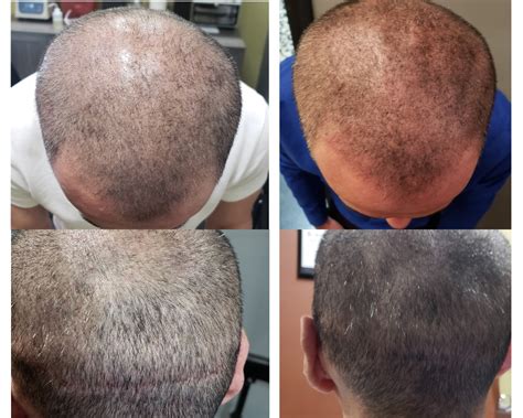 4 Benefits Of Scalp Micropigmentation For Men