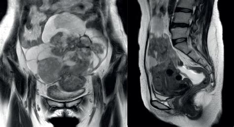 Magnetic Resonance Imaging Was Performed 3 5 Years After Uterine Artery