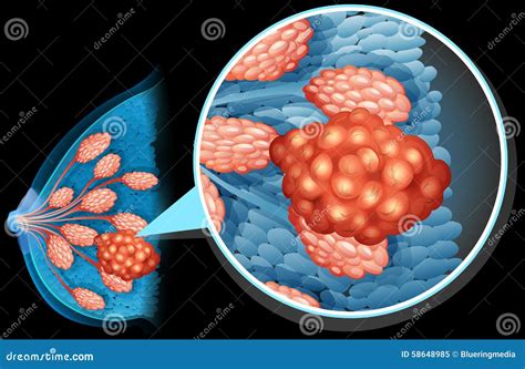 Breast Cancer Diagram Close Up Stock Vector Image