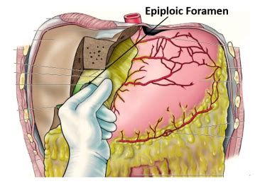 Lesser Sac and Epiploic Foramen , bouundaries and applied aspects , Anatomy QA