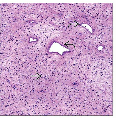 Neurofibroma | Basicmedical Key