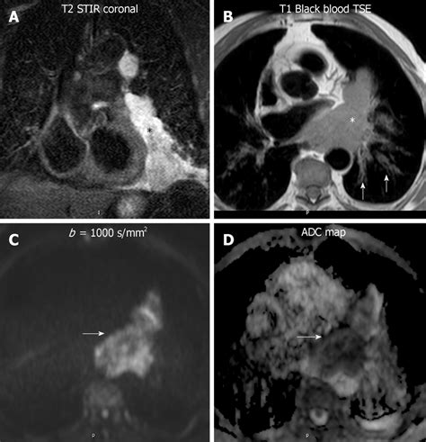 Diffusion Weighted Imaging Of A Lymphoma An 82 Year Old Man With A Download Scientific