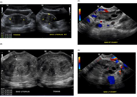 Normal Ovary Transvaginal Ultrasound