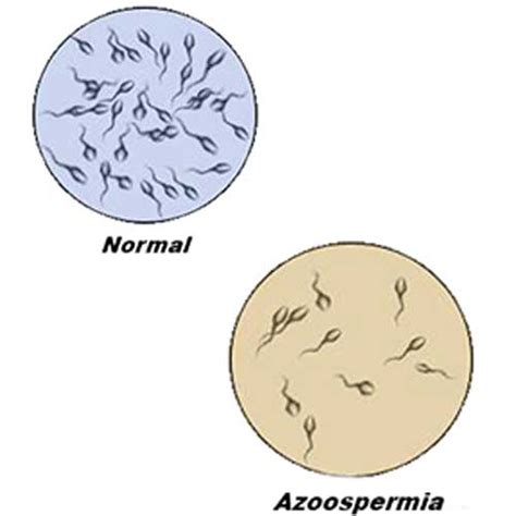 Azoospermia Male Infertility Causes Kjk Hospital And Fertility