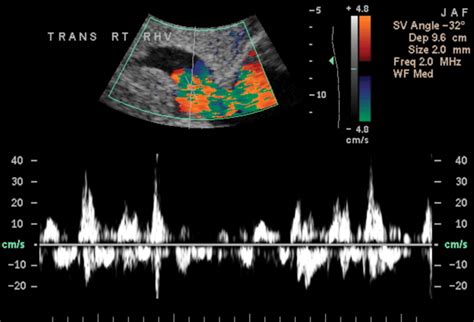 Understanding The Spectral Doppler Waveform Of The Hepatic Veins In