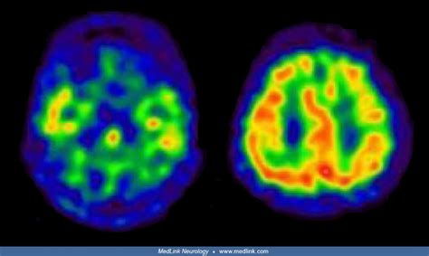 Cerebrotendinous Xanthomatosis Medlink Neurology