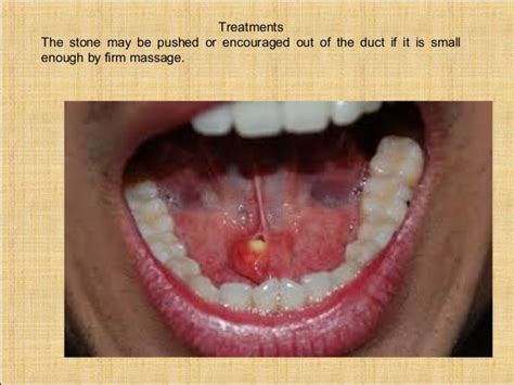 Salivary Surgery