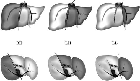 Analysis Of Donor Risk In Livingdonor Hepatectomy The Impact Of