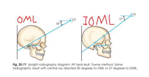 Cranium Facial Bones Paranasal Sinuses Positioning And Evaluation