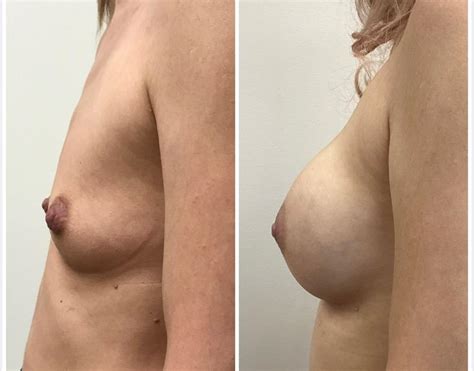 Breast Implant Surgery Utopia Plastic Surgery And Med Spa