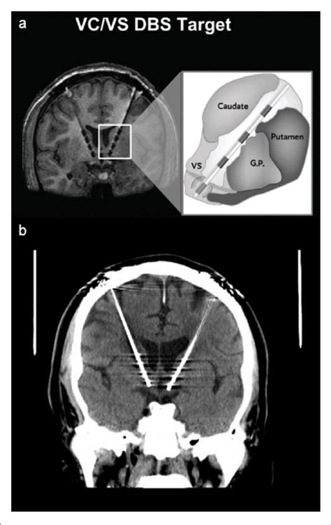 Deep Brain Stimulator Panel A Shows A Schematic Of Deep Brain Download Scientific Diagram