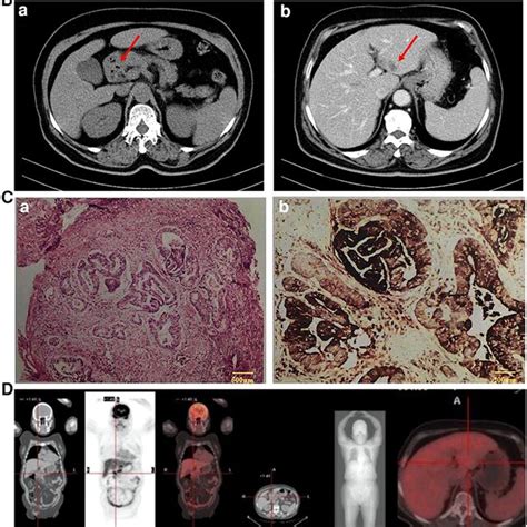 A Ct Examination July 28 2020 Many Slightly Low Density Lesions Download Scientific