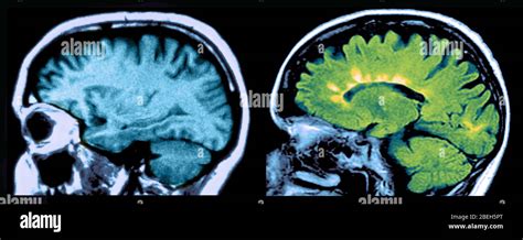 Multiple sclerosis lesions hi-res stock photography and images - Alamy