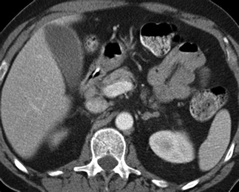 Ct Findings Of Acute Cholecystitis And Its Complications Ajr