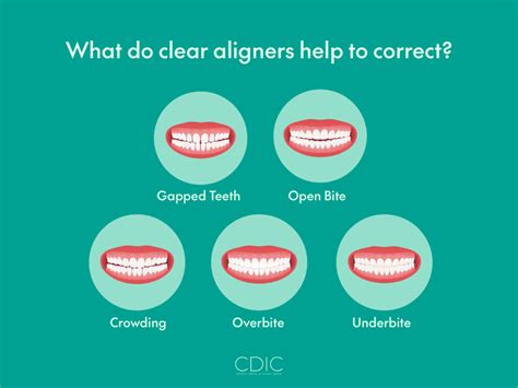 Do Clear Aligners Work A Complete Guide To Treatment Cdic