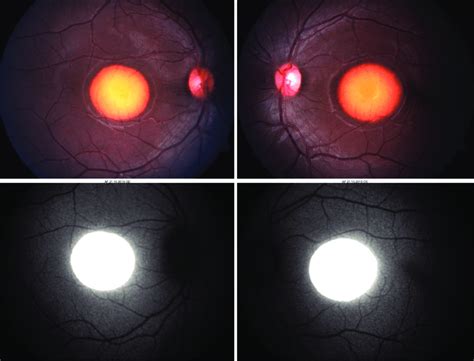 Image representative of Best Vitelliform macular dystrophy in a ...