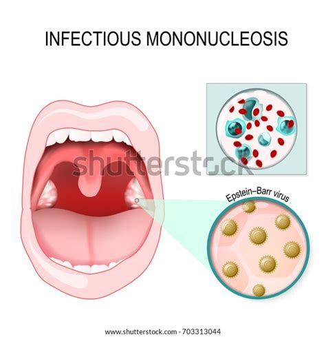 infectious mononucleosis. mouth with pharyngitis. Epstein-Barr virus ...