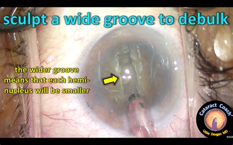 1862: nanophthalmic eye cataract surgery – Cataract Coach™