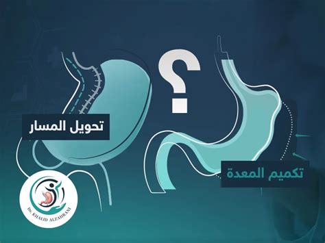 الفرق بين التكميم وتحويل المسارأيهما أفضل؟